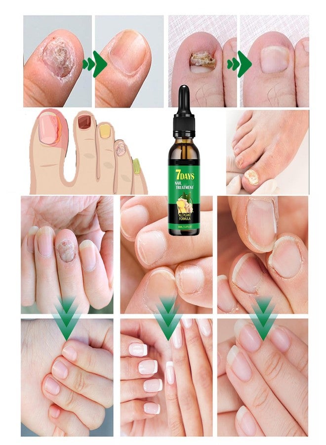 IMOLL Ginger Nail Treatment Nail Support Nail Care, 7days Nail Treatment, Ginger Nail Growth Serum, Ginger Cuticle Care Oil for Nails,Cuticle Serum for Nails (2Pcs, 1 Fl.oz(pack of 1)) - Image 2